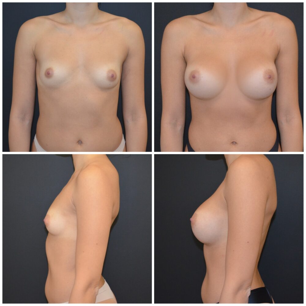 Bröstförstoring hos The Faculty