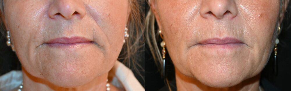 Före- och efterbild av kvinnlig patient som genomgått JULÄINE-behandling. Resultatet en månad efter andra injektionen (höger) visar förbättrad hudtextur, minskade rynkor kring munnen och ett mer återfuktat och jämnt hudintryck.
