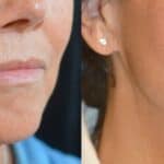 Före- och efterbild av kvinnlig patient som genomgått JULÄINE-behandling. Två månader efter andra injektionen (höger) syns en tydlig förbättring i hudens spänst och struktur med jämnare hudton och minskade linjer kring kinder och mun.