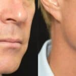 Före- och efterbild av manlig patient som genomgått JULÄINE-behandling. Resultatet två månader efter andra injektionen (höger) visar förbättrad hudstruktur, ökad spänst och jämnare hudton i nedre delen av ansiktet.
