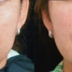 Före- och efterbild av kvinnlig patient som genomgått JULÄINE-behandling. Efterbilden, tagen två månader efter första injektionen, visar förbättrad hudstruktur, ökad lyster och fylligare läppar med ett jämnare intryck kring nedre ansiktet.