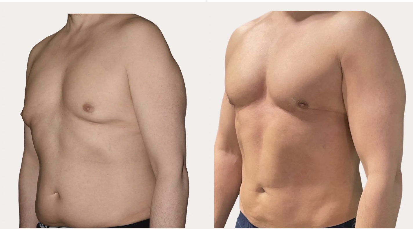 Före efter Manlig bröstförminskning (Gynekomasti)